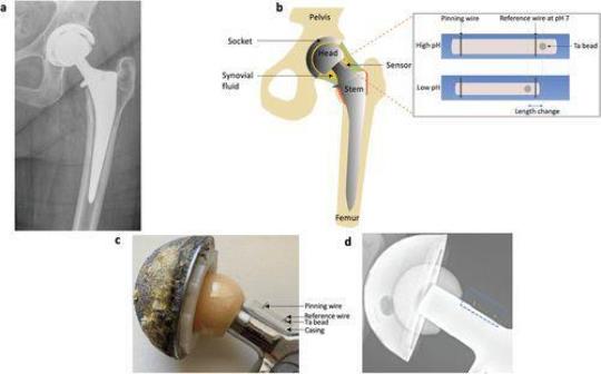 智能膝关节植入物使用传感器保护关节免受损伤  智能假体和植入
