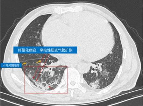 新型冠状病毒感染的肺炎胸部影像学是