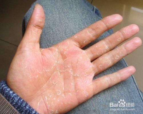 手癣最佳治疗 手癣的症状图片